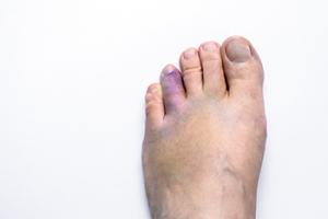 Broken Toe and Nerve Injury