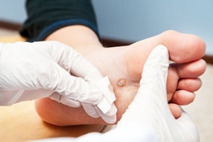 Plantar Warts and Their Causes