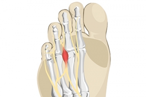 Spotting the Symptoms of Morton’s Neuroma