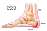 Gentle Stretches for Sever's Disease